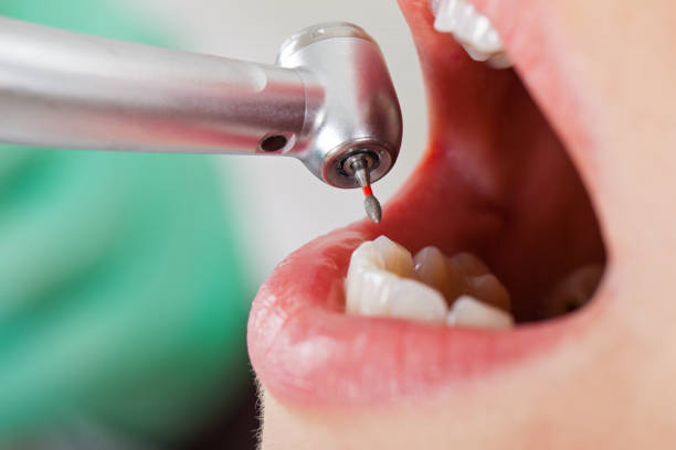 Best Knocked-Out Tooth (Avulsed Tooth) Treatment in Salisbury, MD